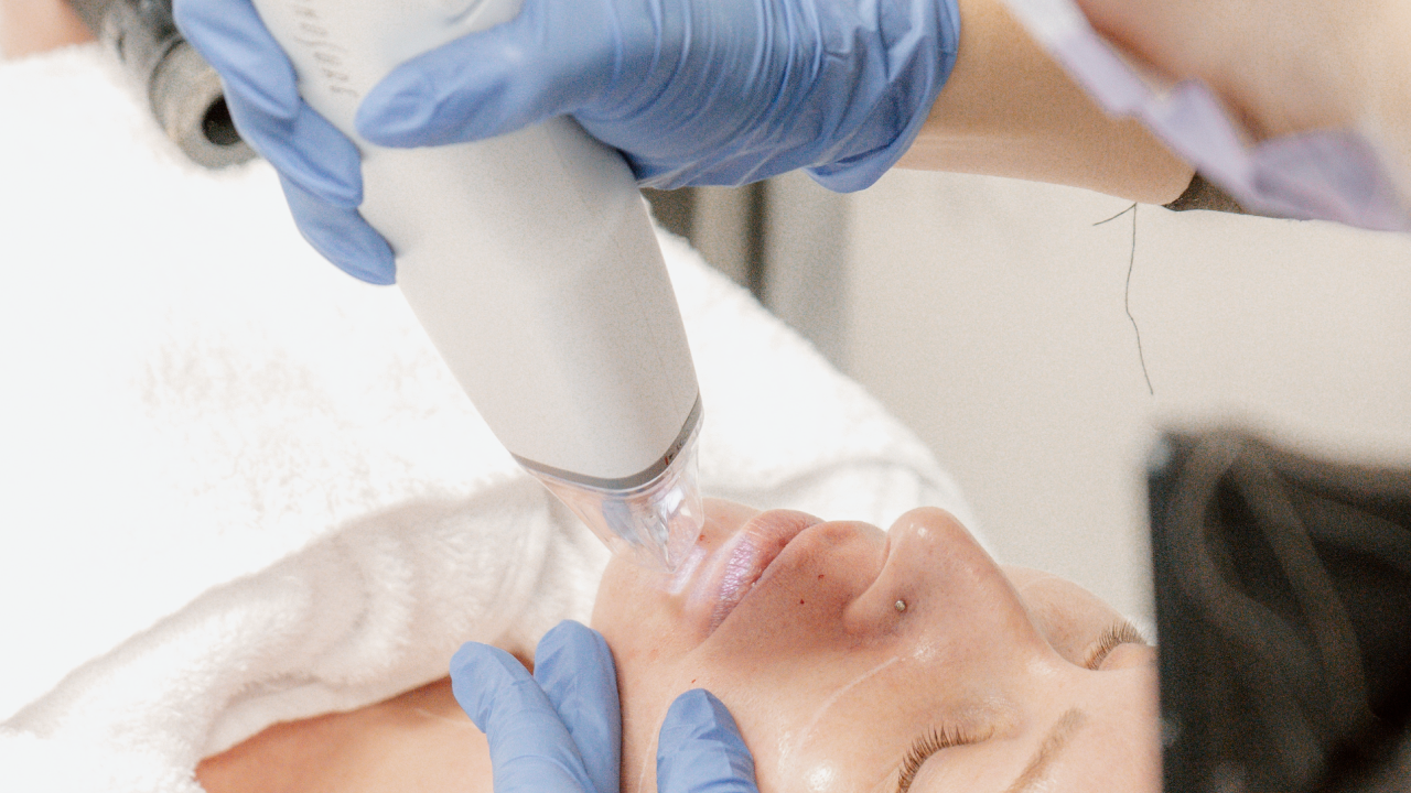 Potenza™ RF Microneedling in Vancouver, BC 8 West Cosmetic Surgery